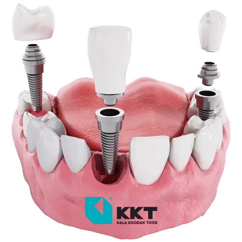 Dental Implants good or bad Dental Implants good or bad