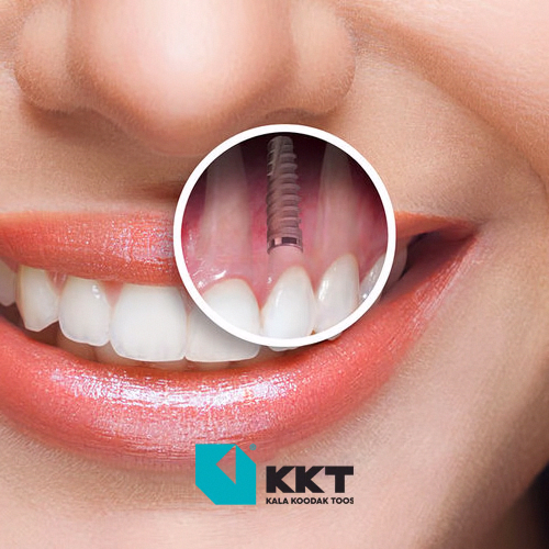 Dental implant and smile Dental implant and smile