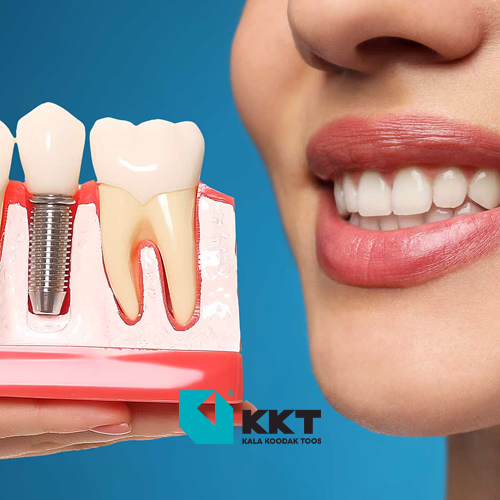 Dental implant Dental implant